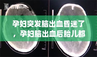 孕妇突发脑出血昏迷了，孕妇脑出血后胎儿都怎么办了 